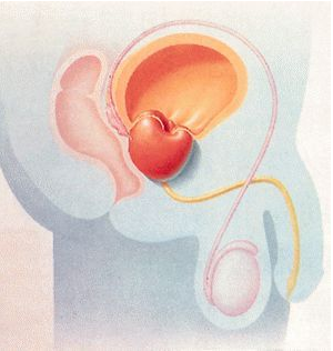 前列腺增生早期治疗的常见误区